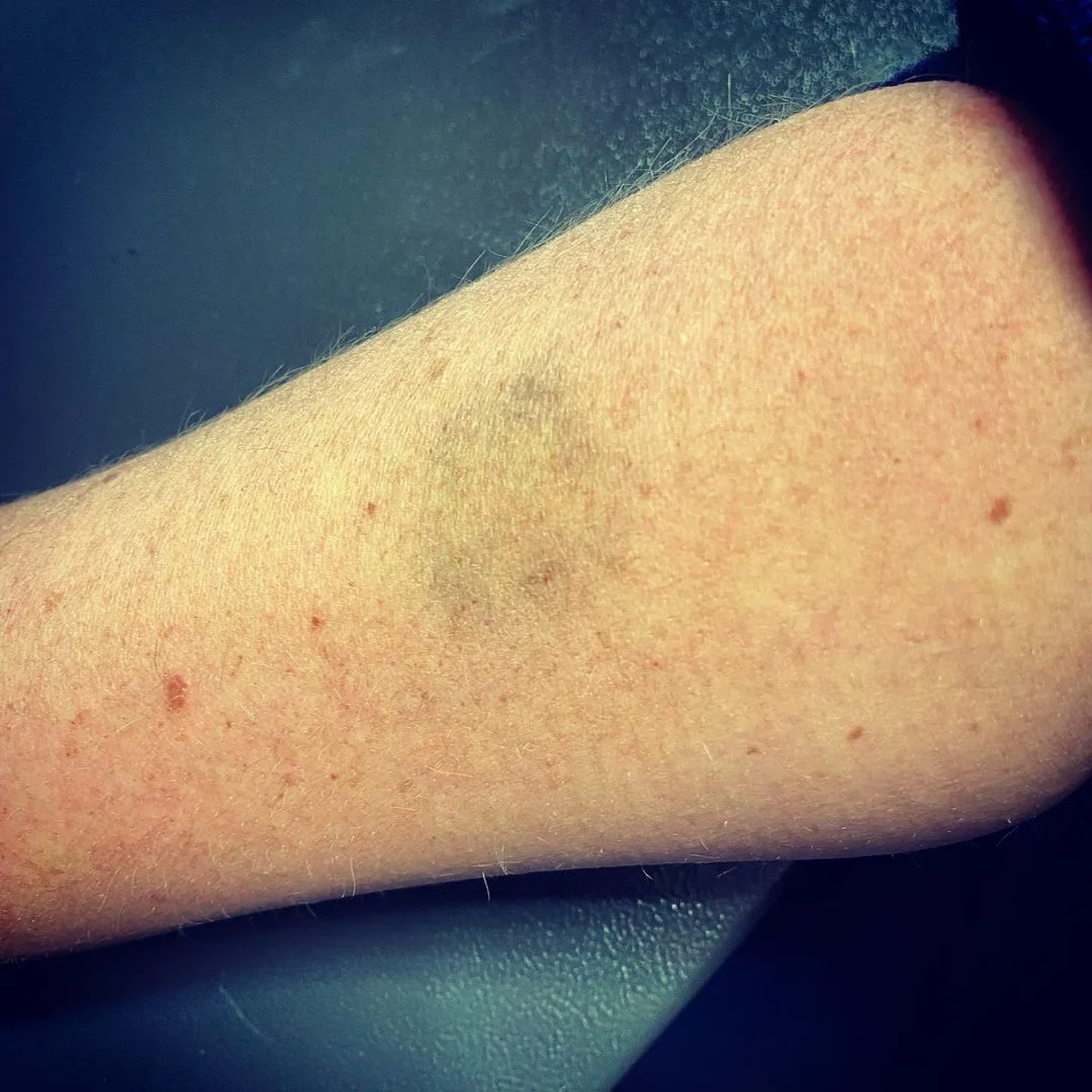 Image of a horse bite on a person's forearm