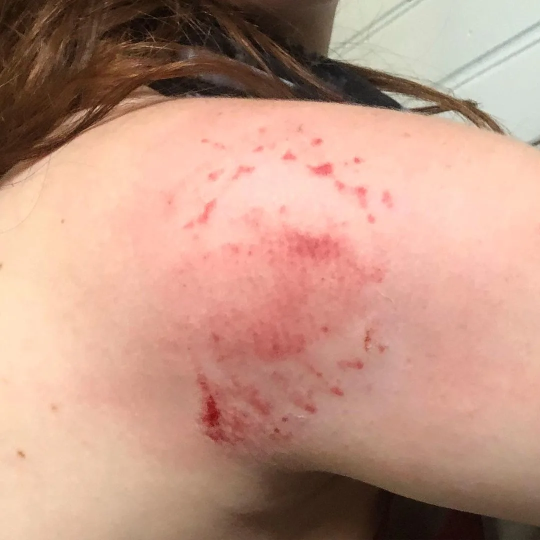image of a person's shoulder that has been bitten by a horse